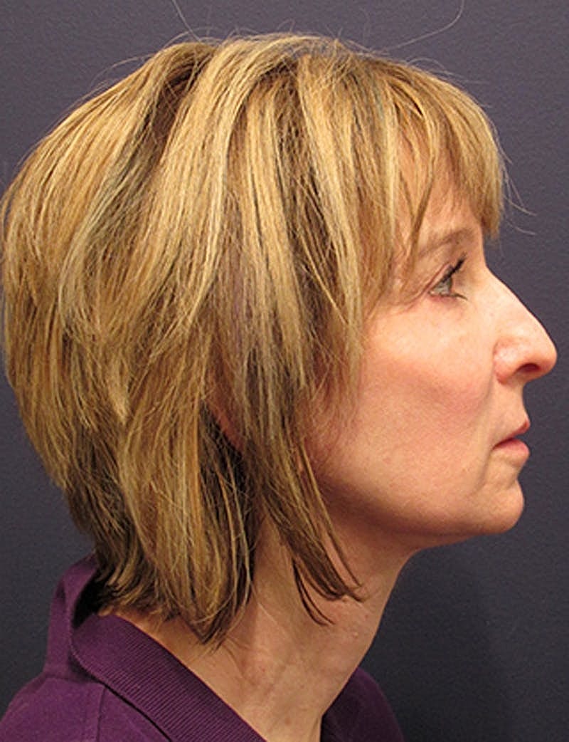 Facelift Before & After
