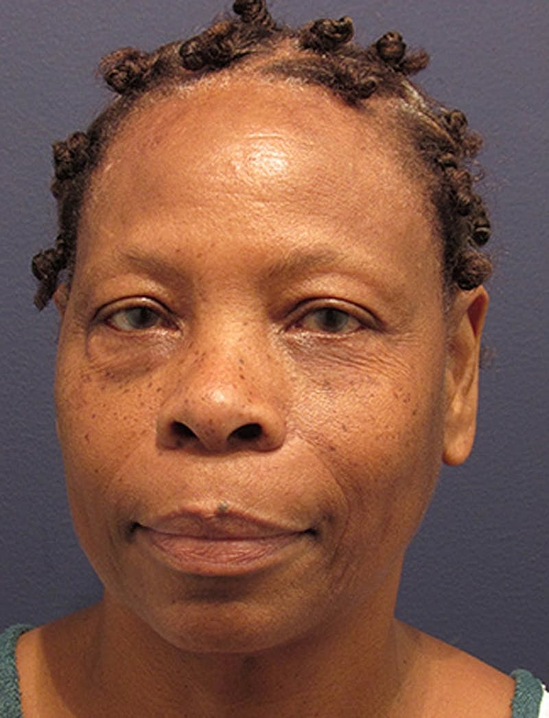 Facelift Before & After