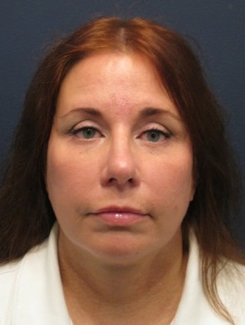 Facelift Before & After