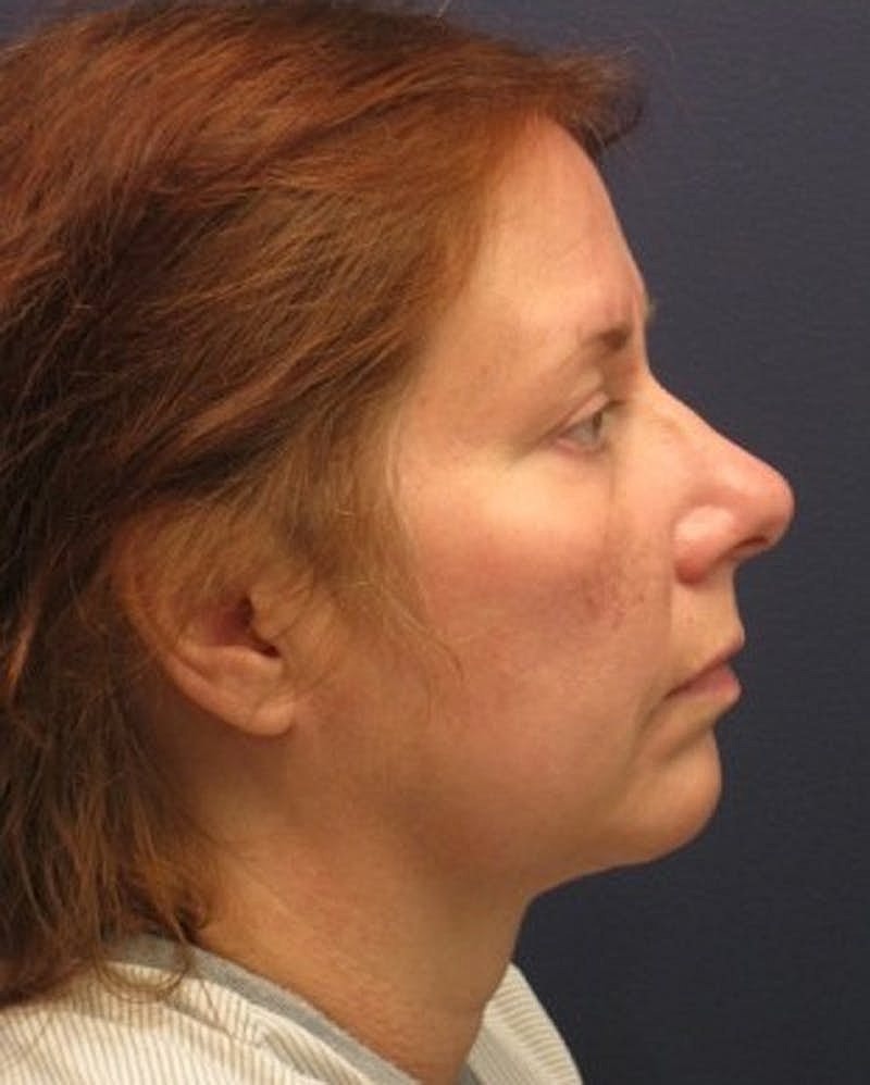 Facelift Before & After