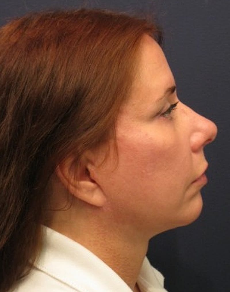 Facelift Before & After