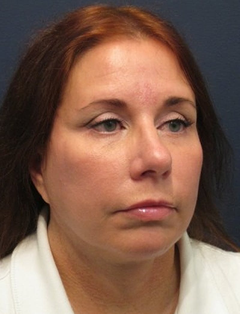 Facelift Before & After