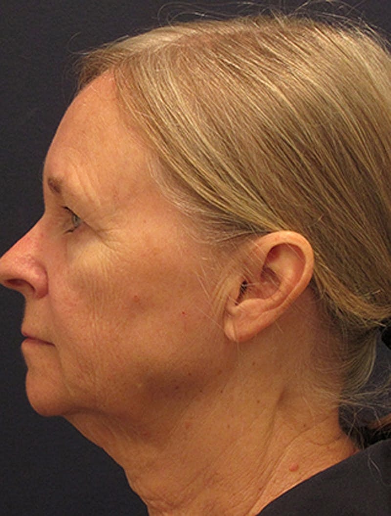 Facelift Before & After