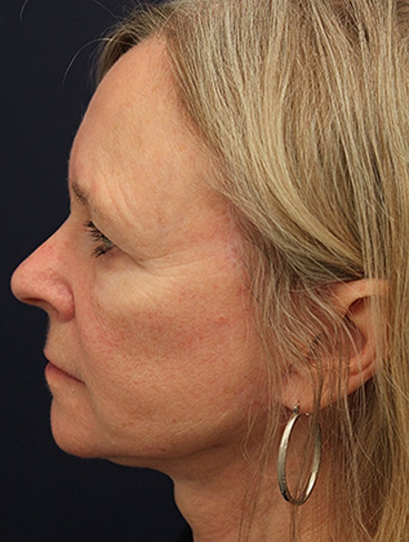 Facelift Before & After