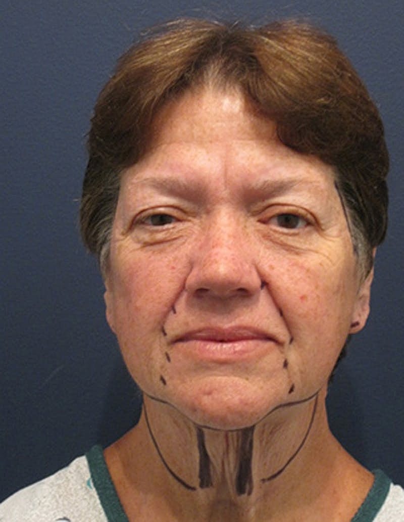Facelift Before & After