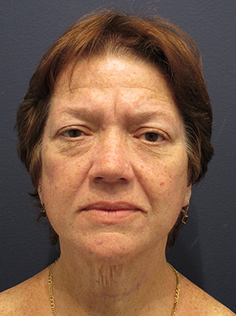Facelift Before & After