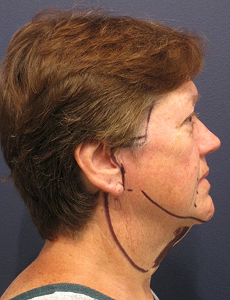 Facelift Before & After