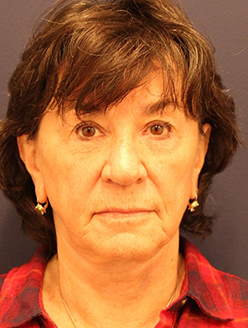 Facelift Before & After