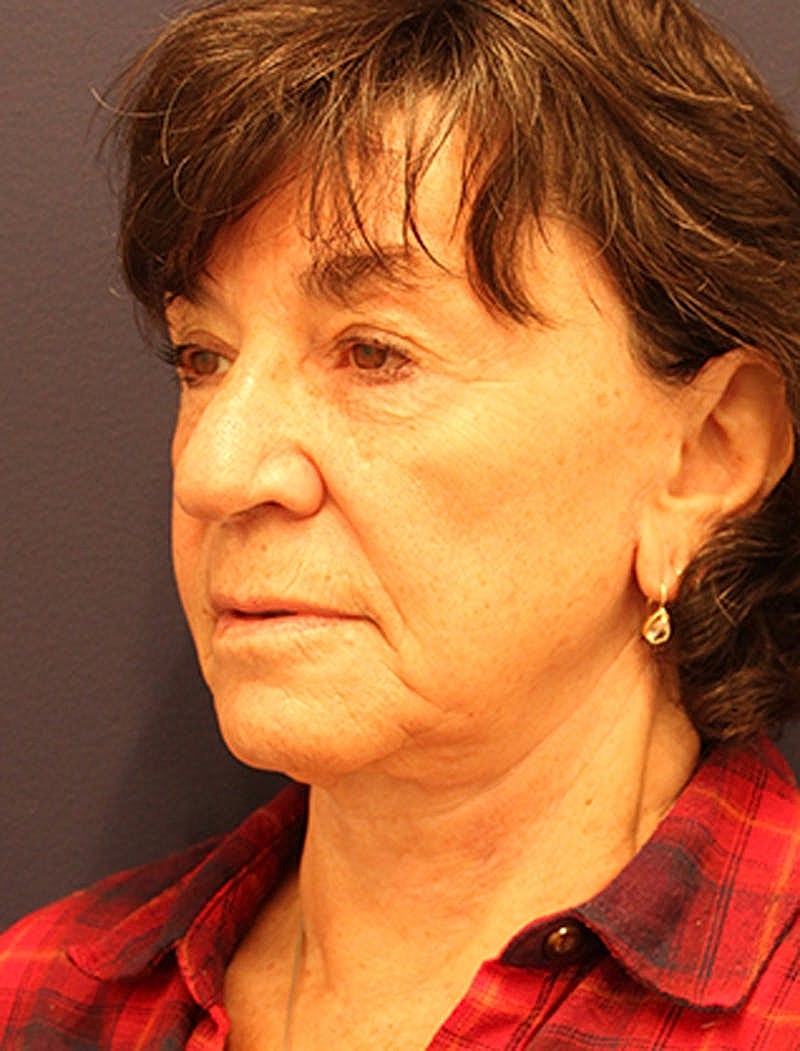 Facelift Before & After