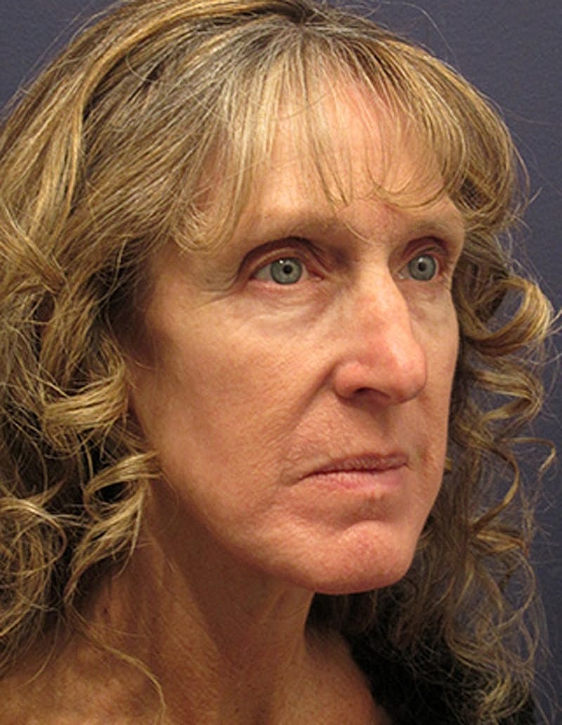 Facelift Before & After