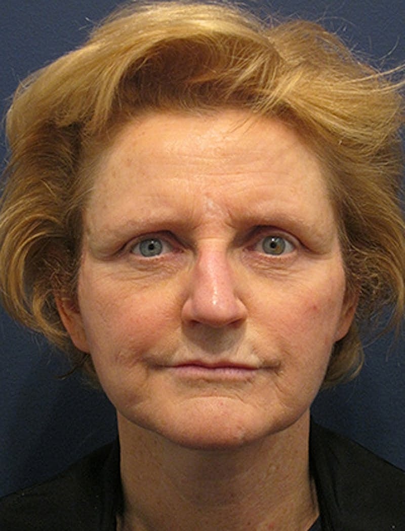 Facelift Before & After