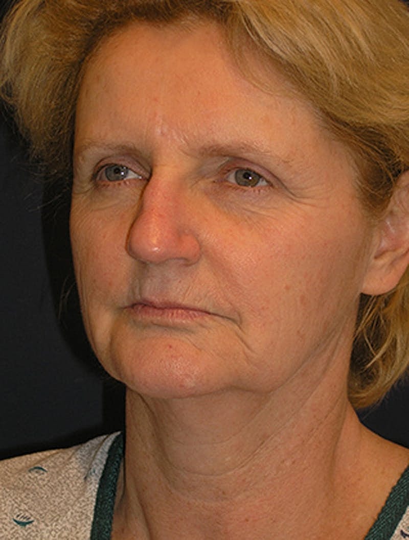 Facelift Before & After