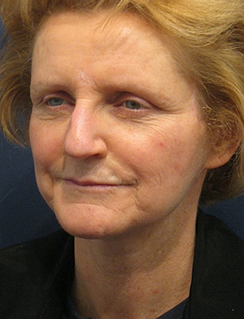 Facelift Before & After