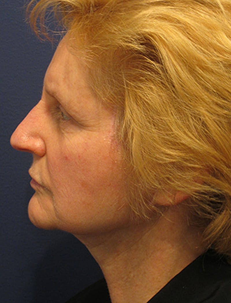 Facelift Before & After