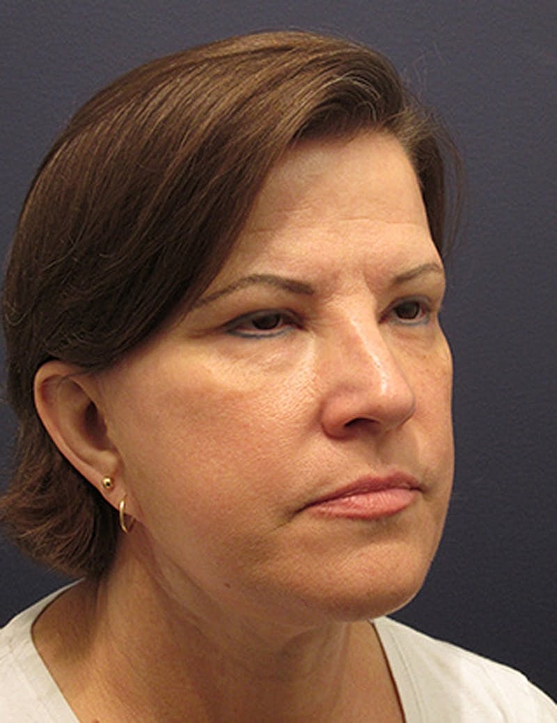 Facelift Before & After