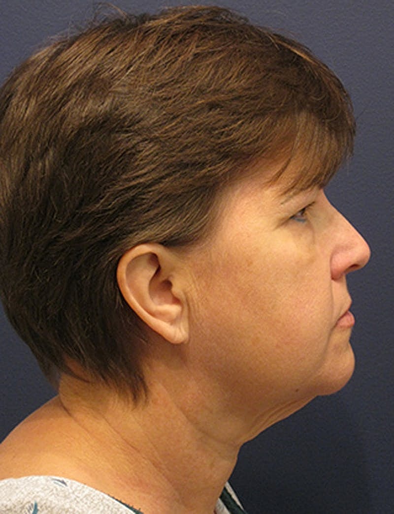 Facelift Before & After