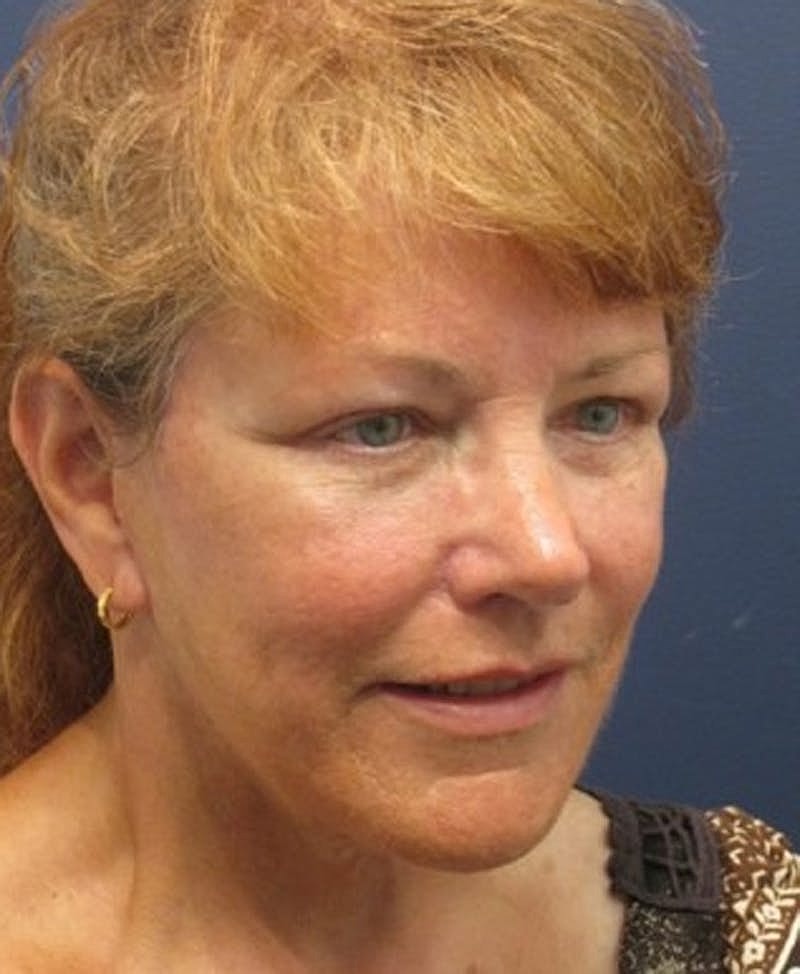 Facelift Before & After