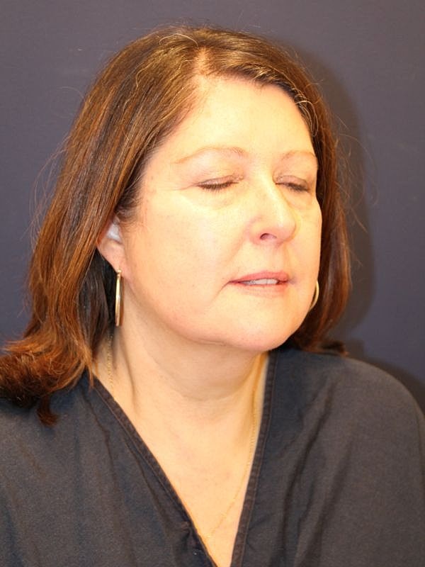 Facelift Gallery Before & After