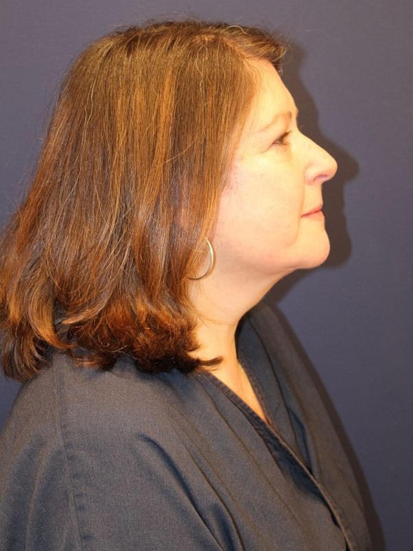 Facelift Gallery Before & After