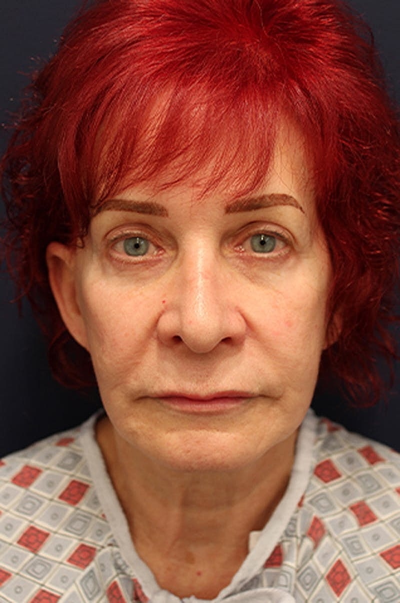 Rhinoplasty Before & After