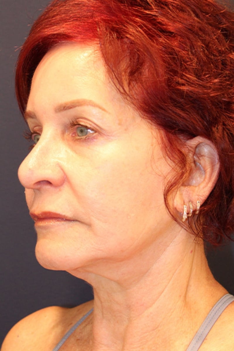 Rhinoplasty Before & After