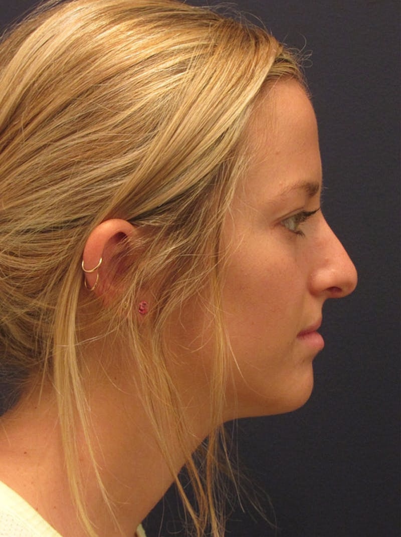 Rhinoplasty Before & After