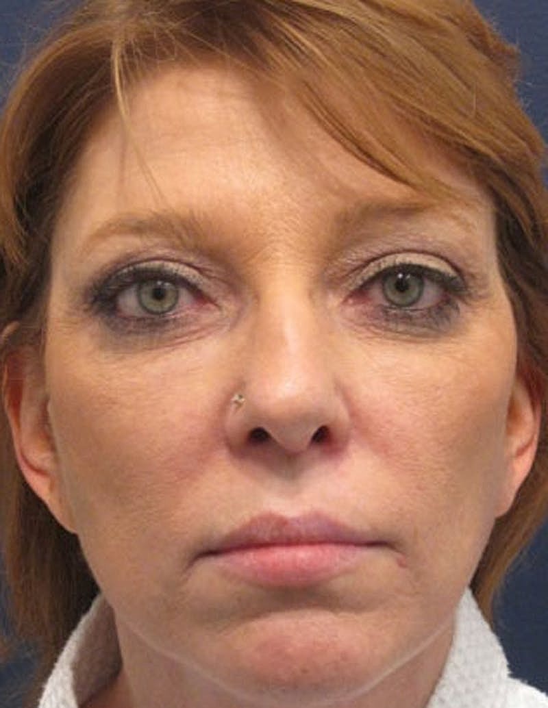 Rhinoplasty Before & After