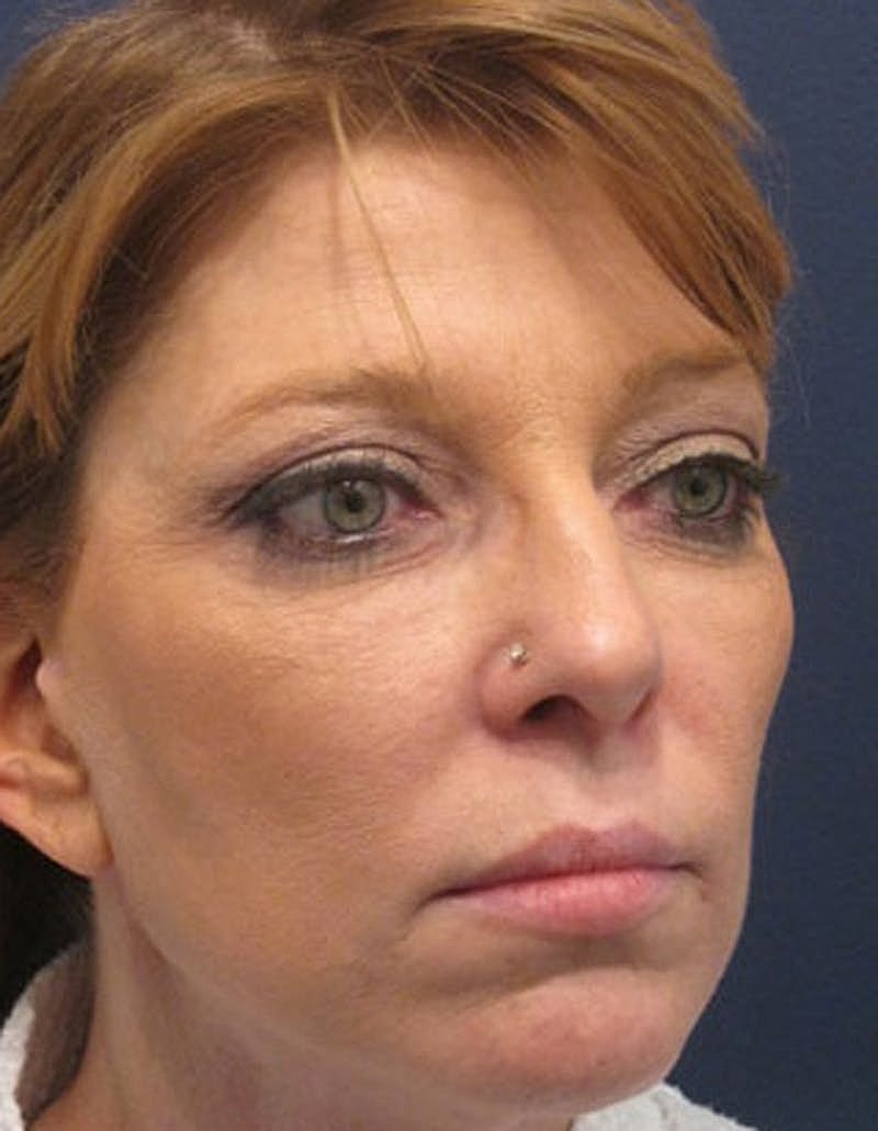 Rhinoplasty Before & After