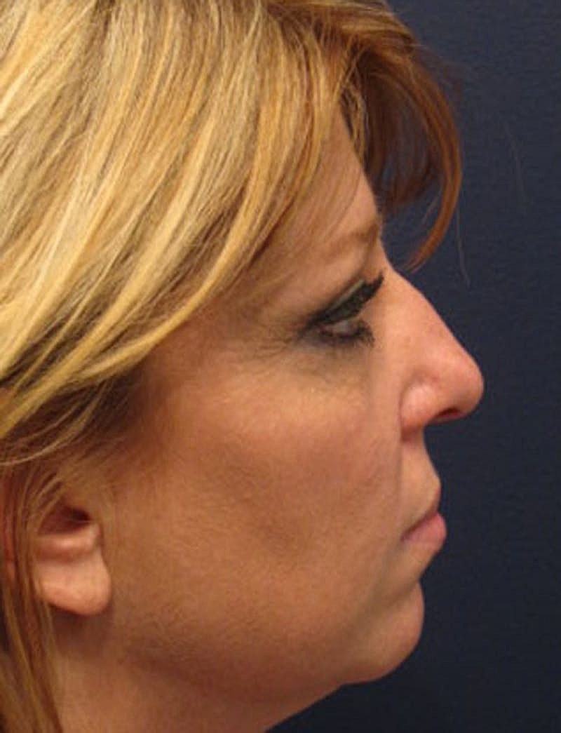 Rhinoplasty Before & After