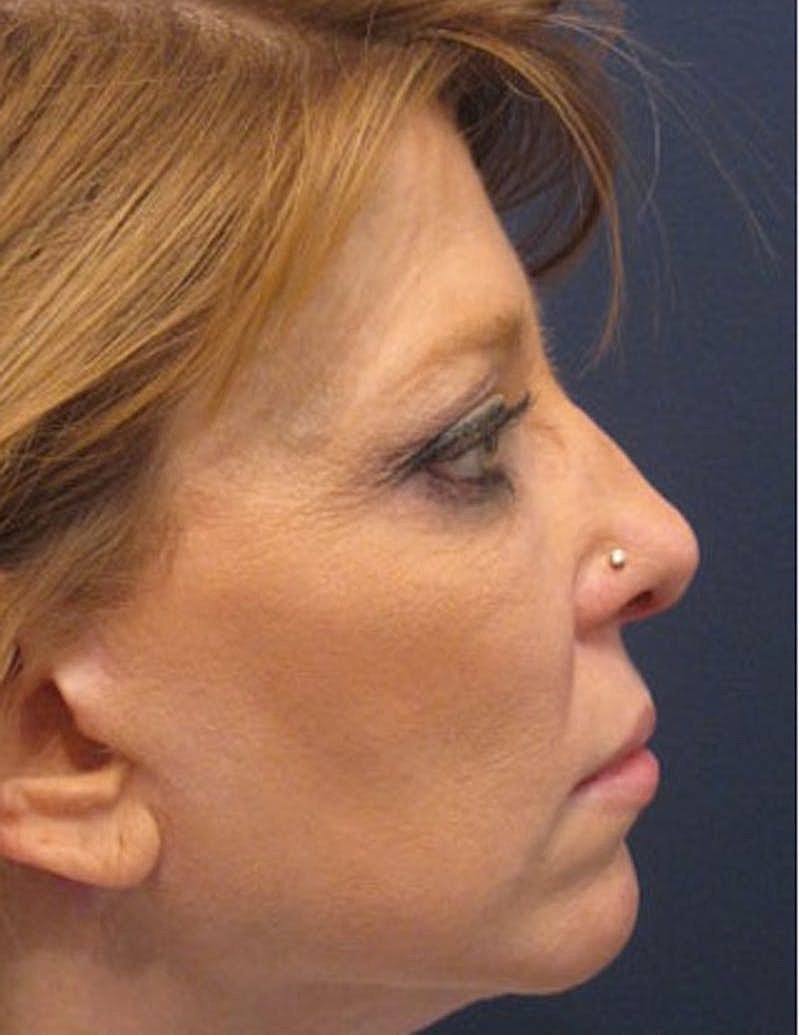 Rhinoplasty Before & After