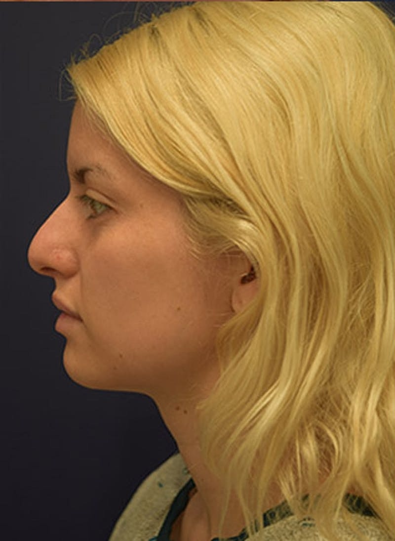 Rhinoplasty Before & After