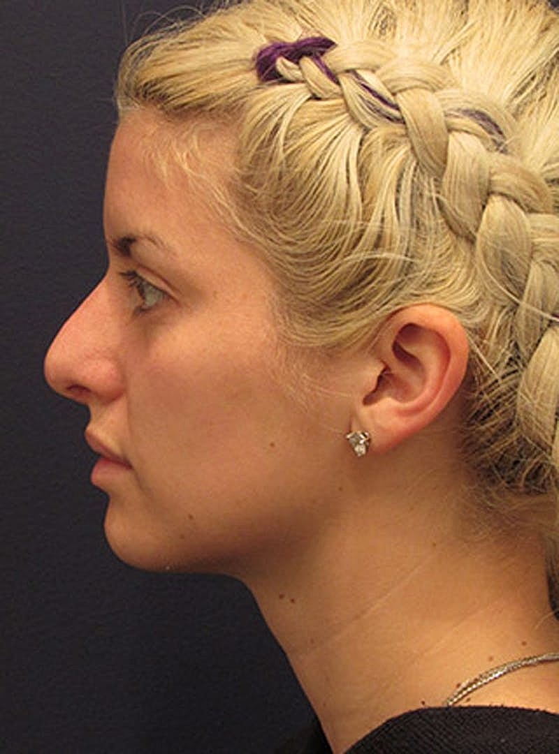 Rhinoplasty Before & After