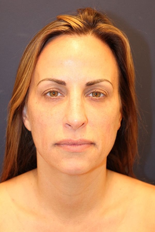 Rhinoplasty Gallery Before & After