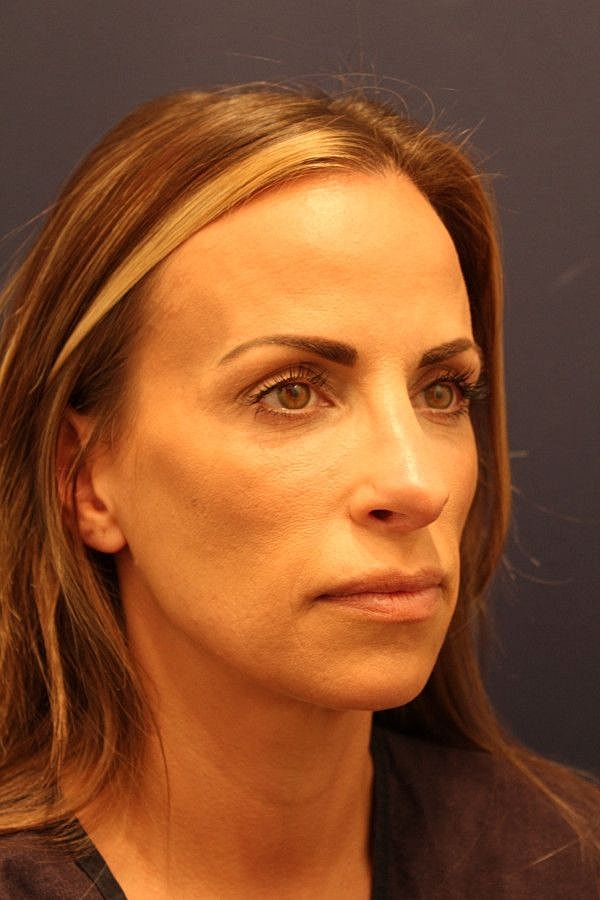 Rhinoplasty Gallery Before & After