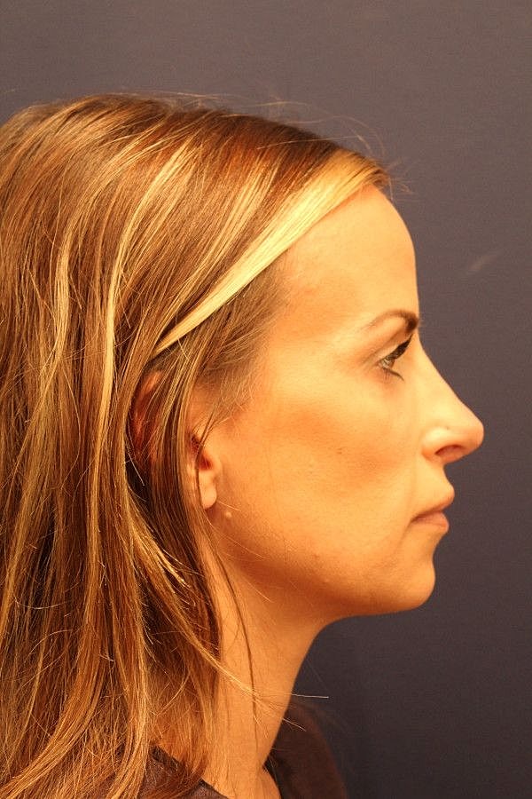 Rhinoplasty Gallery Before & After