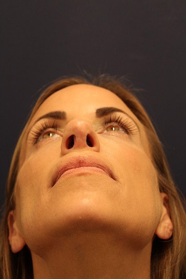 Rhinoplasty Gallery Before & After