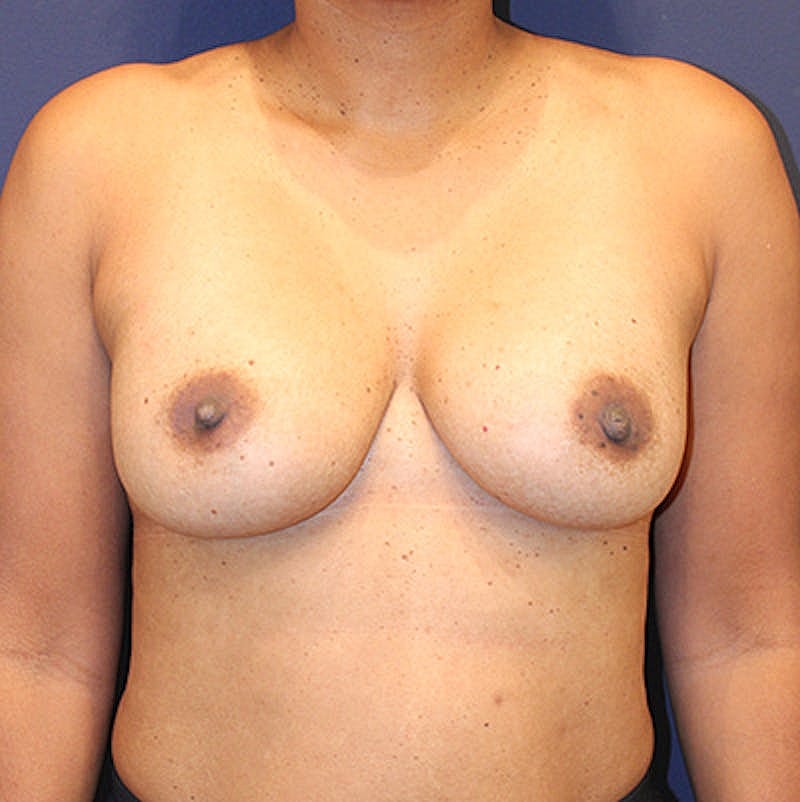 Breast Augmentation Before & After