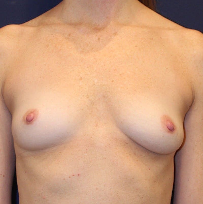 Breast Augmentation Before & After