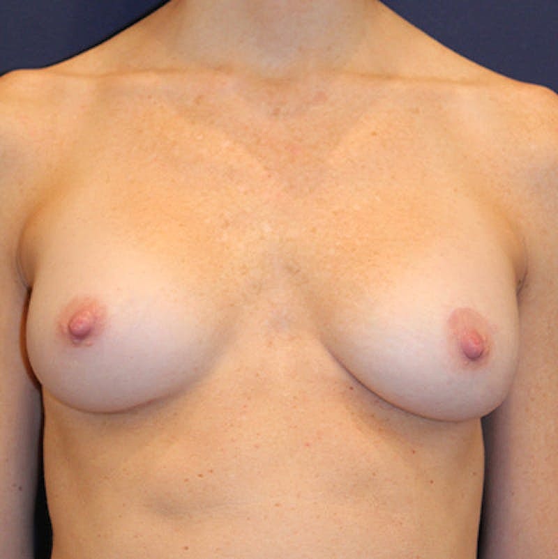 Breast Augmentation Before & After