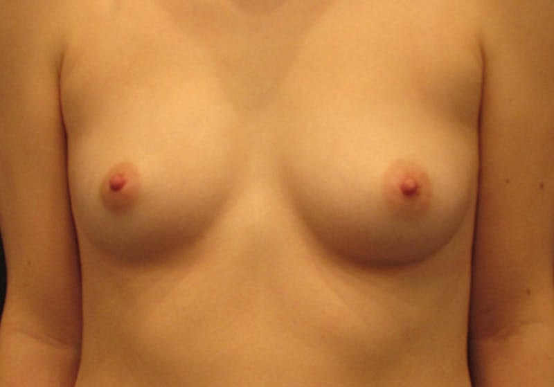 Breast Augmentation Before & After