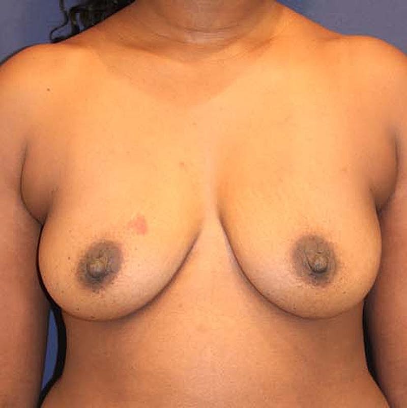 Breast Augmentation Before & After