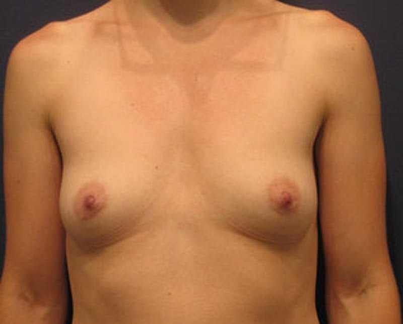 Breast Augmentation Before & After