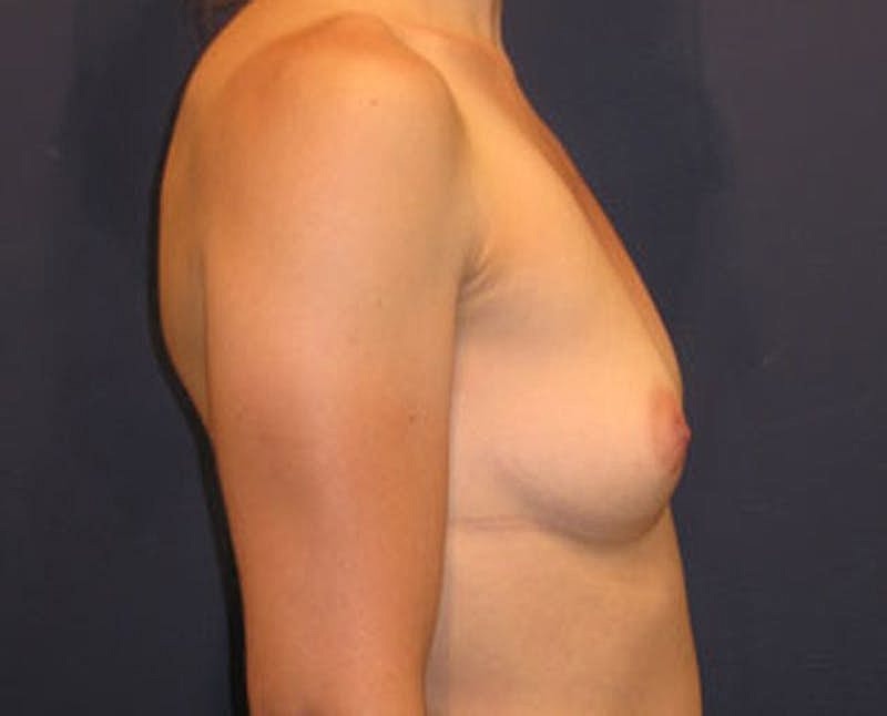 Breast Augmentation Before & After
