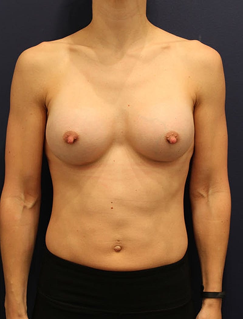 Breast Augmentation Before & After