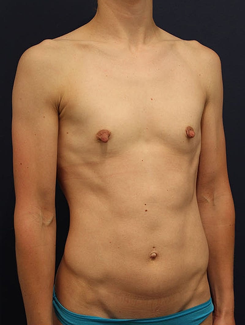 Breast Augmentation Before & After