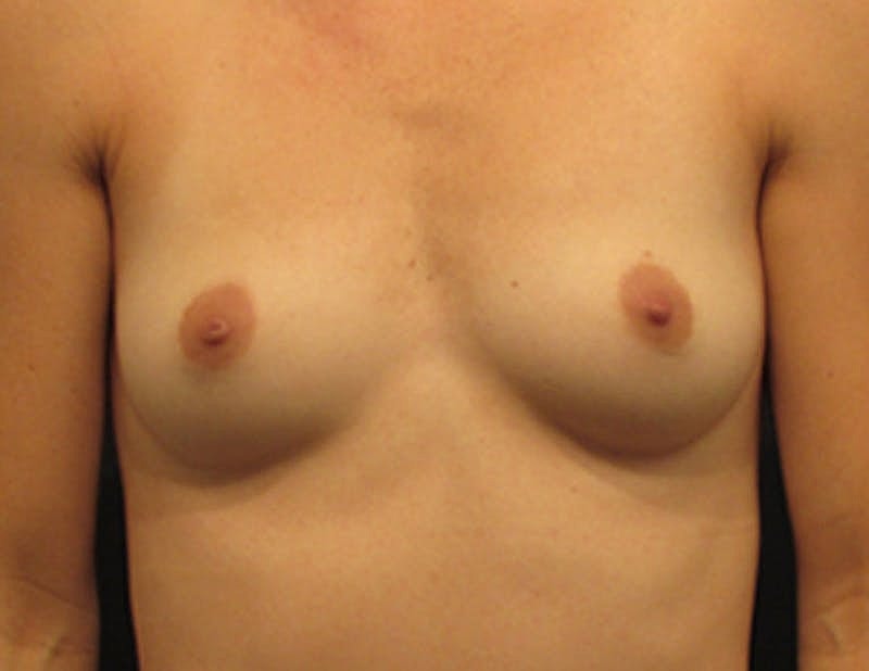 Breast Augmentation Before & After
