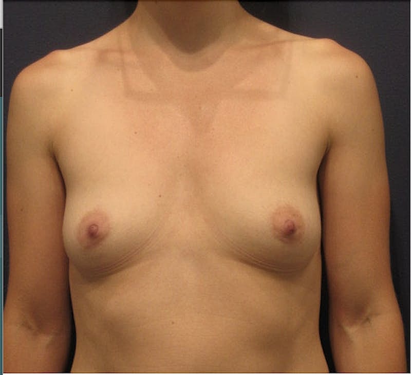 Breast Augmentation Before & After