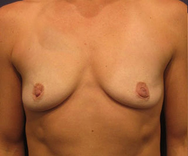 Breast Augmentation Before & After