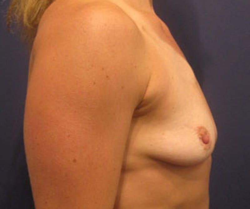 Breast Augmentation Before & After