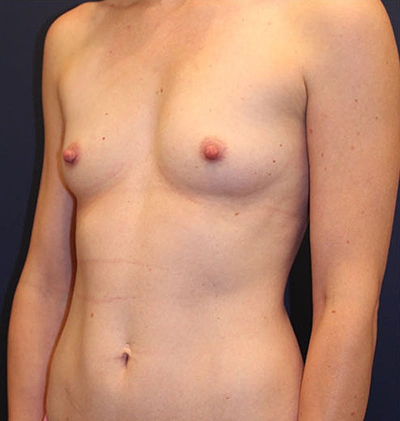 Breast Augmentation Before & After